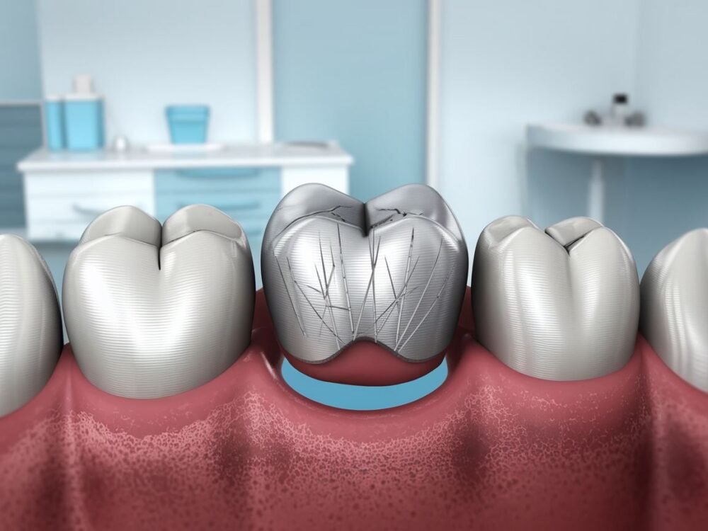 metalowa korona dentystyczna